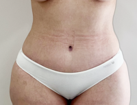 Abdominoplasty Before and After Photos