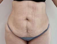 Abdominoplasty Before and After Photos